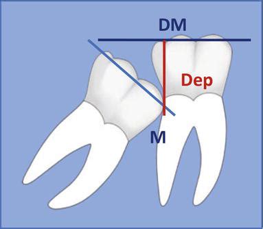 first and second molars|Impacted First and Second Permanent Molars: Overview .